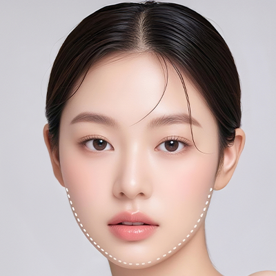 필러실리프팅